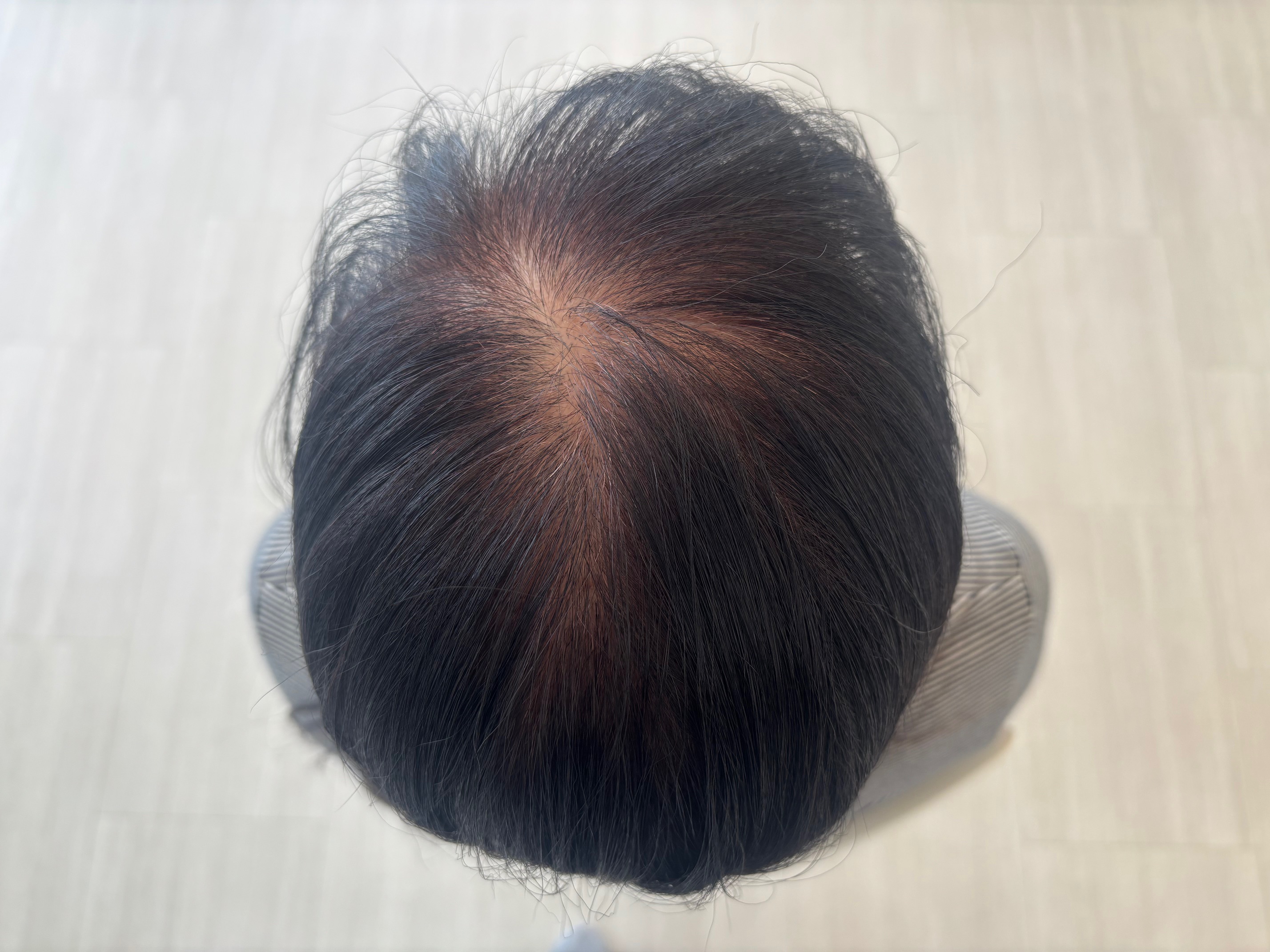 発毛ケア開始時の頭頂部